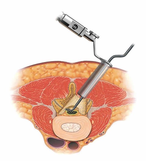 Decompression-Lumbar-Laminectomy